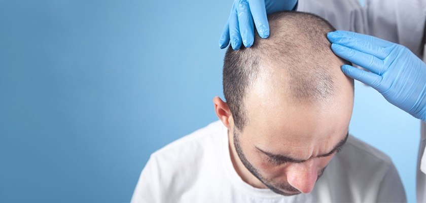 Hair Transplant