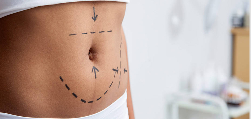 Cost of a Tummy Tuck in Turkey: Surprisingly Affordable!