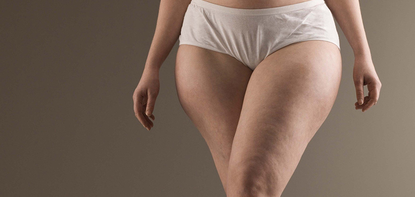 How Long Does Recovery Take After Thigh Lift?