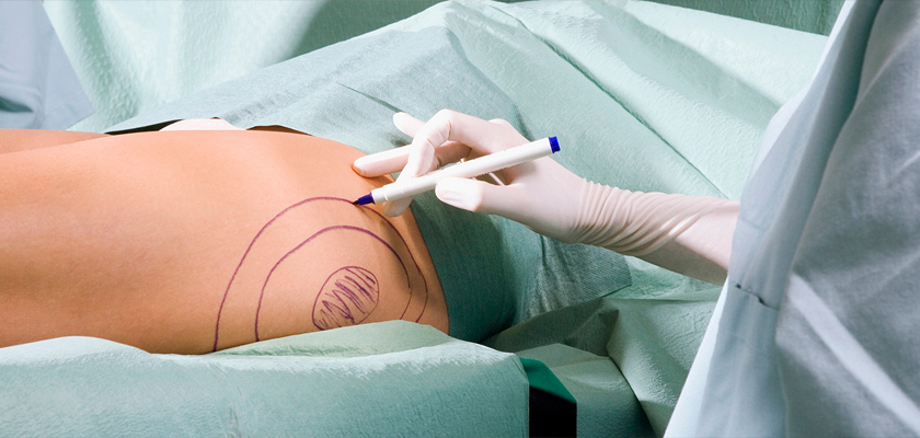 Why Liposuction Surgery in Turkey is the Best?