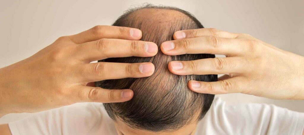 Why is Turkey the Best Option for Hair Transplant?