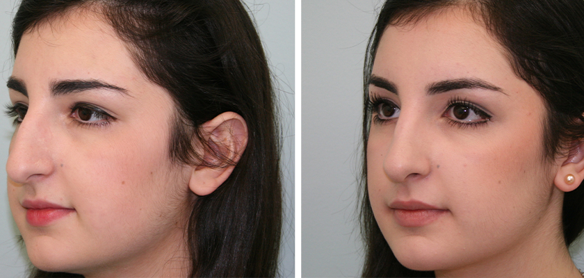 What Are the Advantages of Getting Nose Surgery in Turkey?