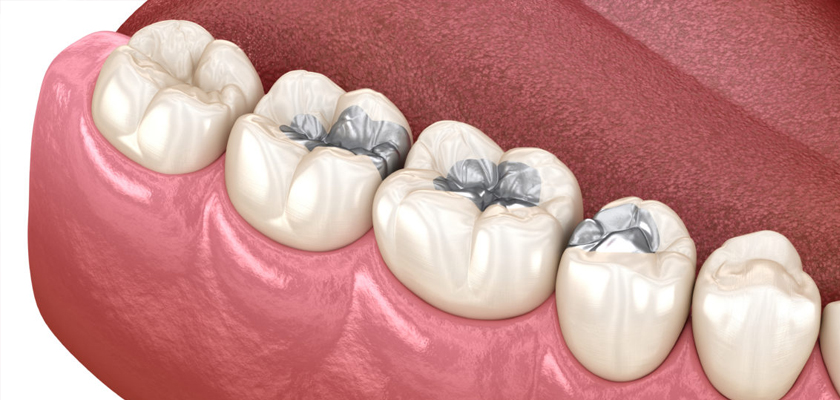 Tooth Fillings in Turkey: Cost, Procedure & Treatment Abroad!