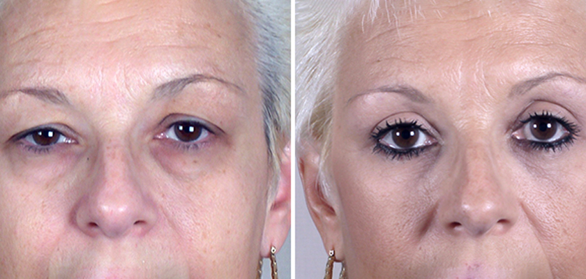 What Does Eyelid Surgery Recovery Look Like?