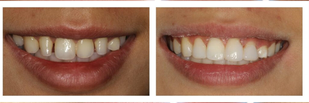 Who Can Get Dental Composite Bonding in Turkey?