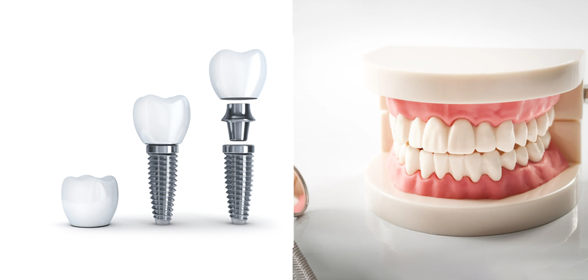 Why Should You Opt for Dental Implants Instead of Dentures?