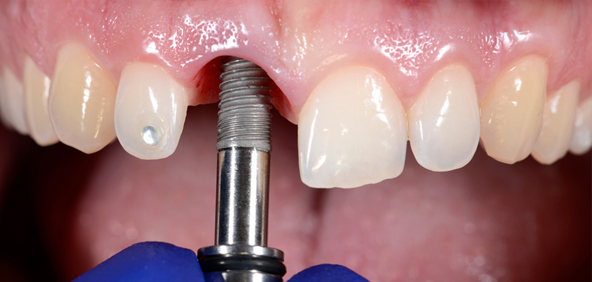 Here Are Some Signs that Indicate You Need Dental Implants!