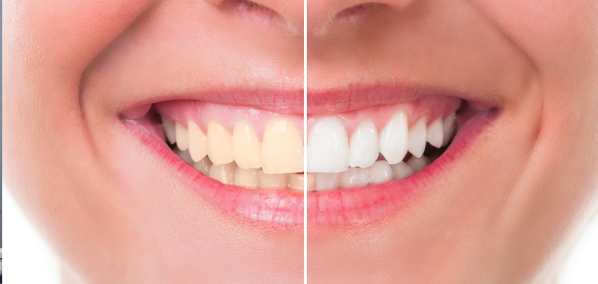 Teeth Whitening Turkey- Is It Safe?