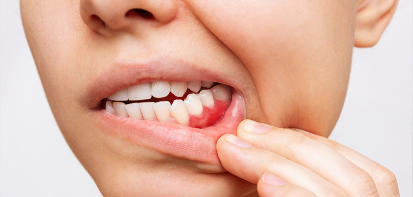 Why Gum Disease Treatment in Turkey is Worth Trying!