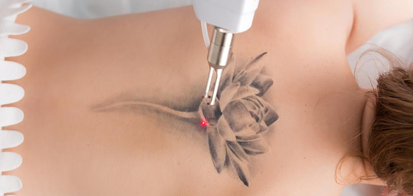 Things to Consider When Getting Tattoo Removal in Turkey!