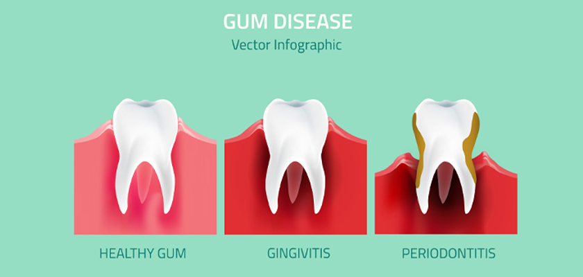 What Are the Benefits of Gum Disease Treatment?