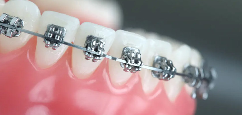 Types of Braces to Choose From!