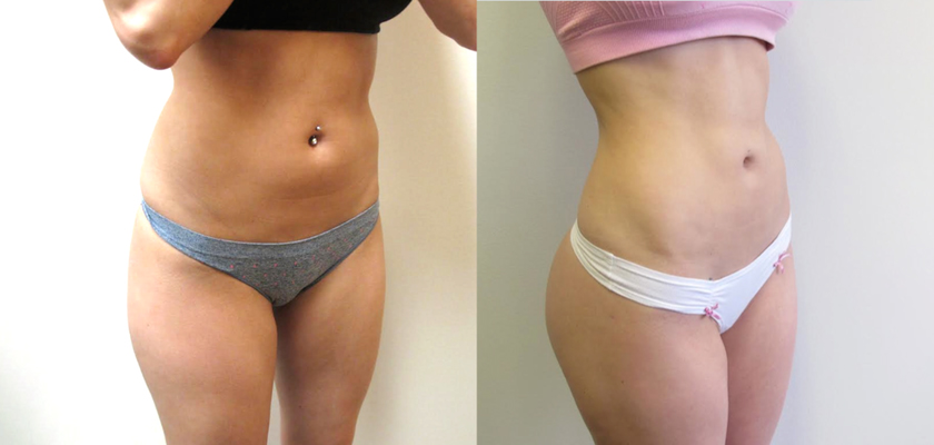 Things You Need to Know About Liposculpture Procedure in Turkey