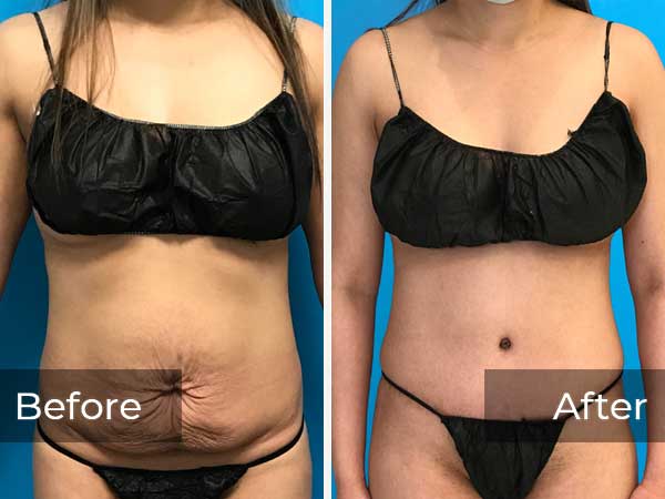 before and after lipo 360