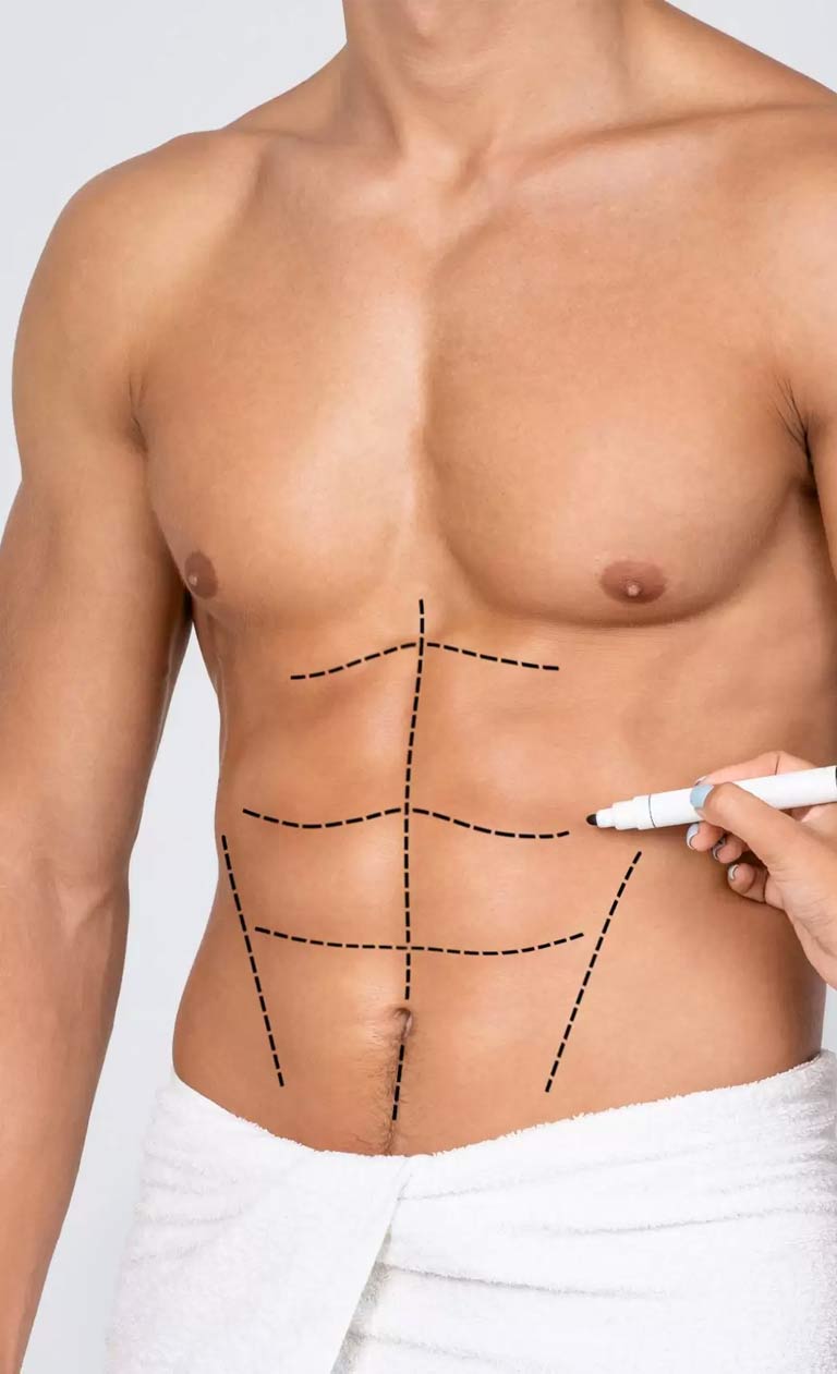 abdominal etching in turkey