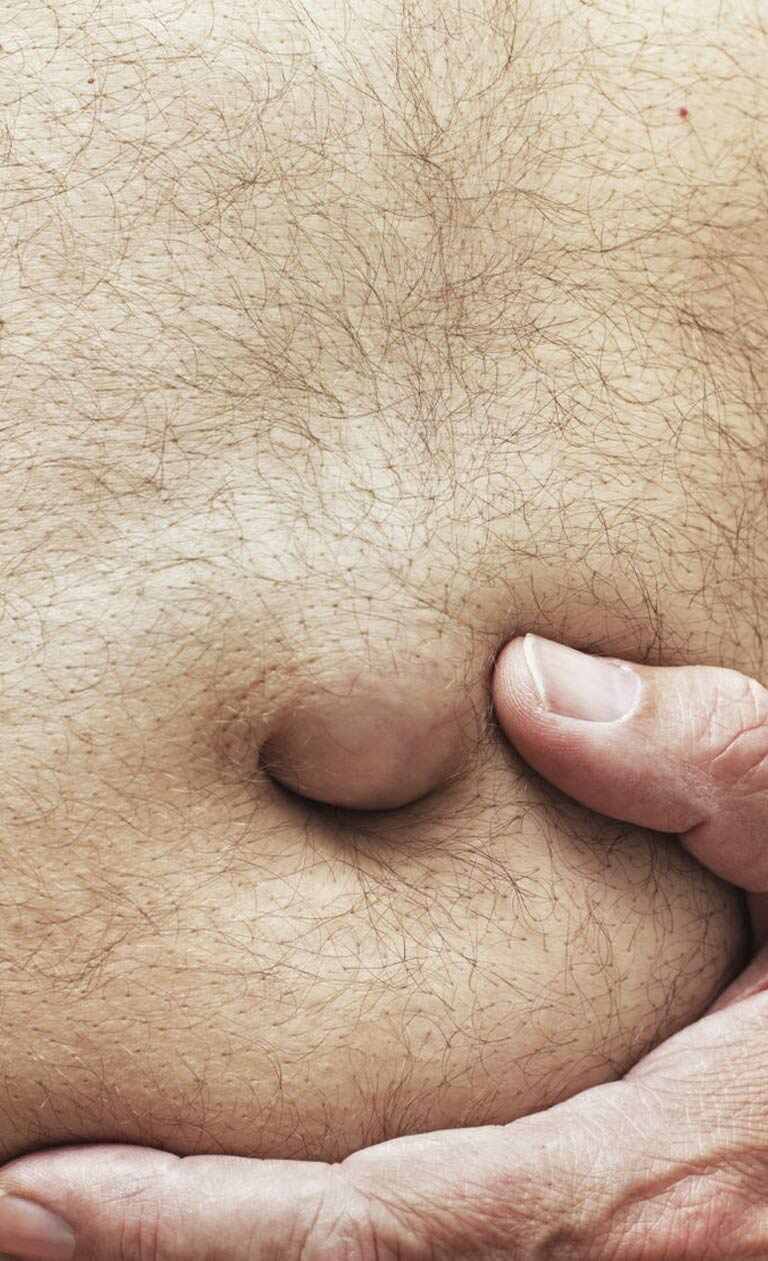 abdominal hernia surgery in turkey